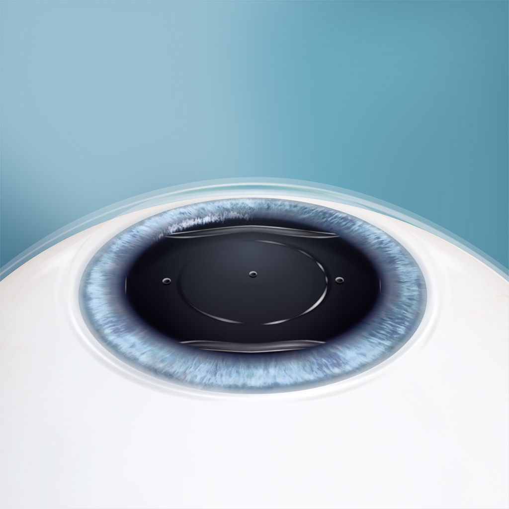 EVO Visian ICL in eye